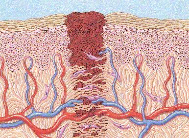 A schematic illustration of a healing wound